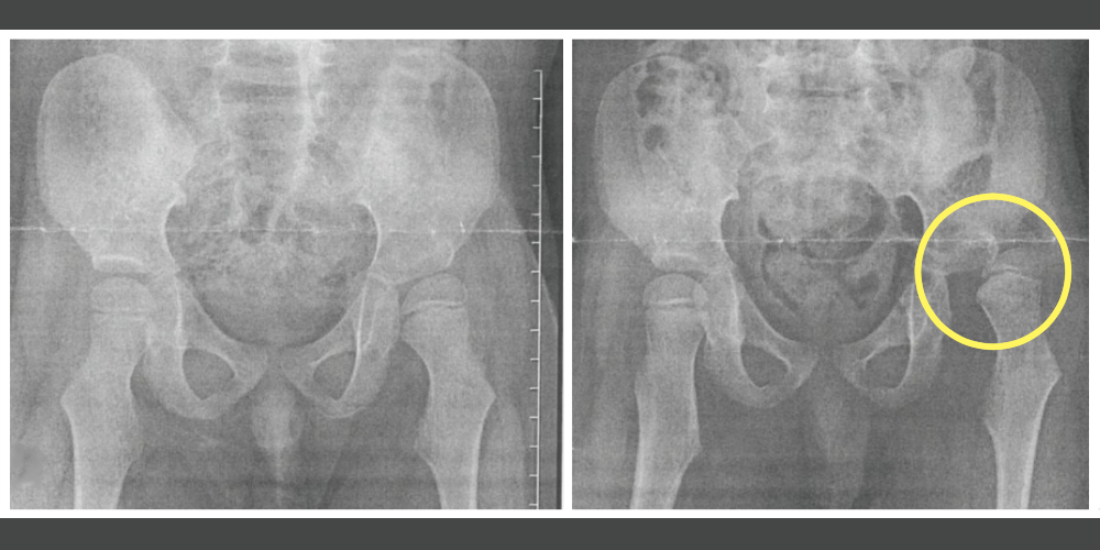 亜脱臼している股関節のレントゲン画像